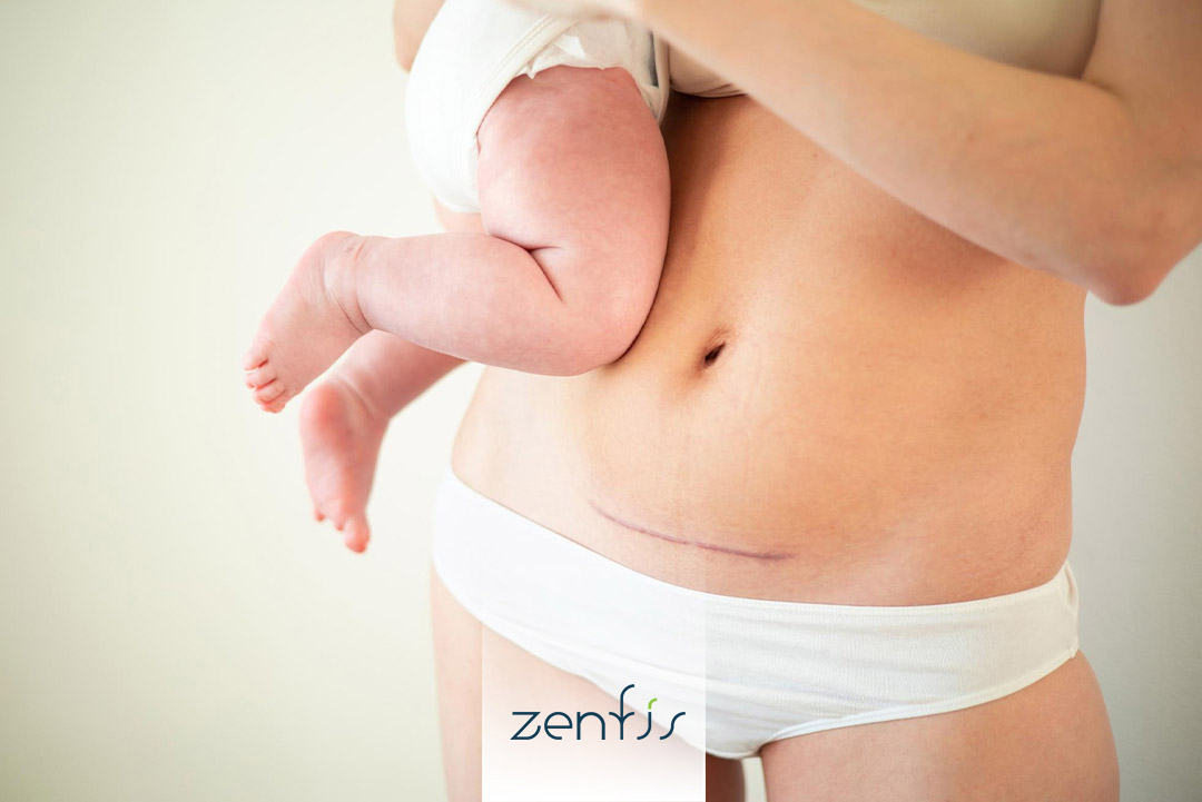 cámara hiperbárica en Cartagena para post parto por cesárea